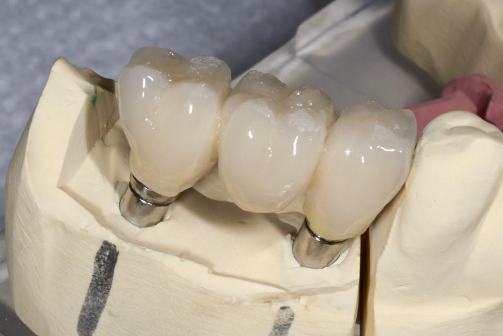mouth model for dental implants